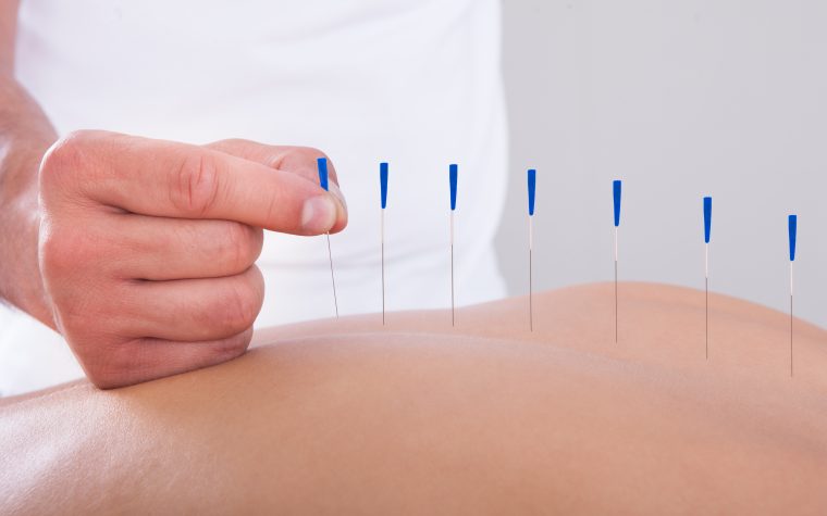 acupuncture trial