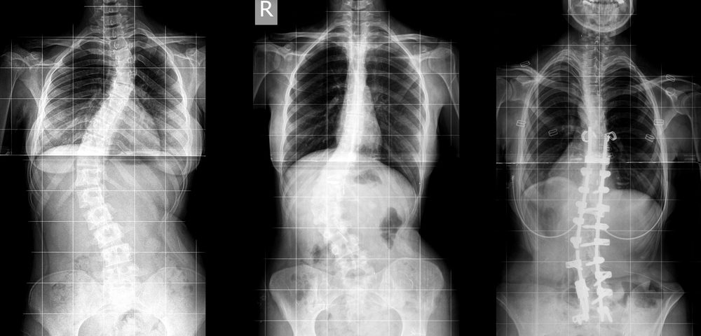 Surgery Essential to Manage Scoliosis in Children, Study Says