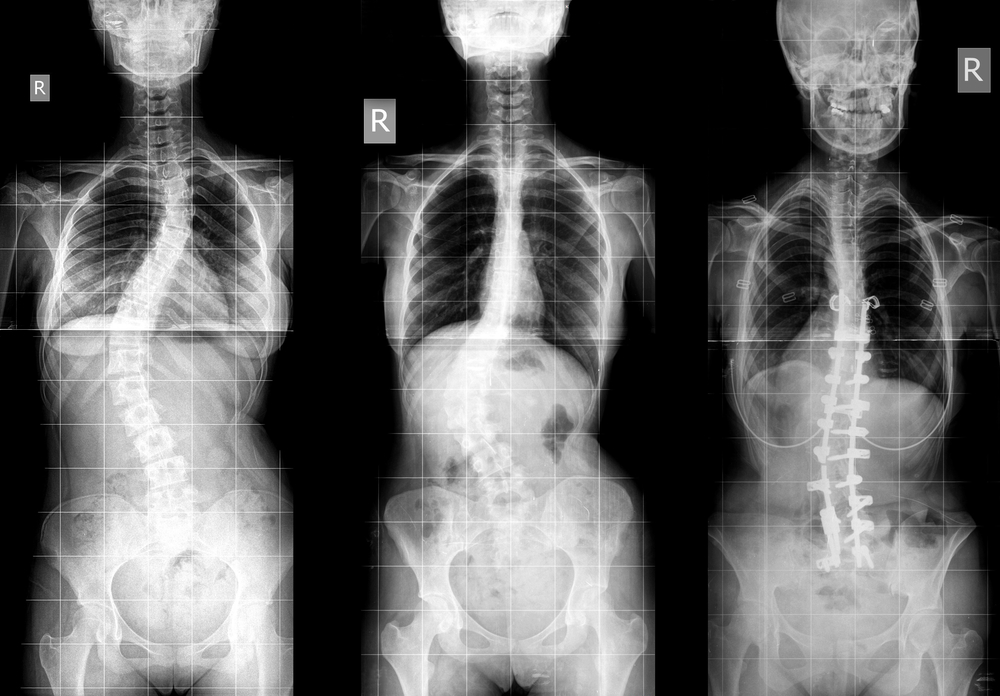 Cerebral palsy and scoliosis